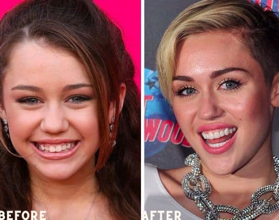 Miley Cyrus is known for her teeth veneers