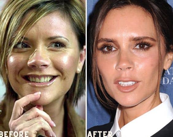 Victoria Bachham is among the celebrities who has veneers on their teeth