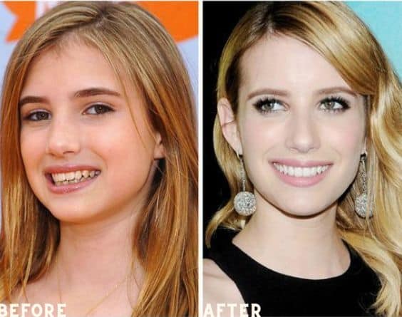 one of the celebrities with veneers teeth is Emma Roberts