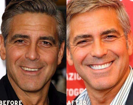 George Clooney with veneers before after