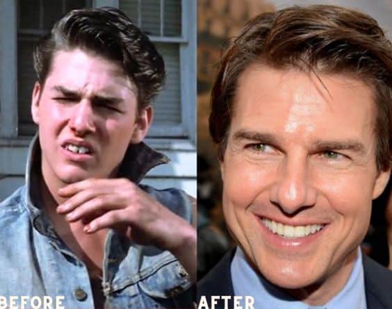 Tom Cruise is one of the celebrities with veneers on his teeth
