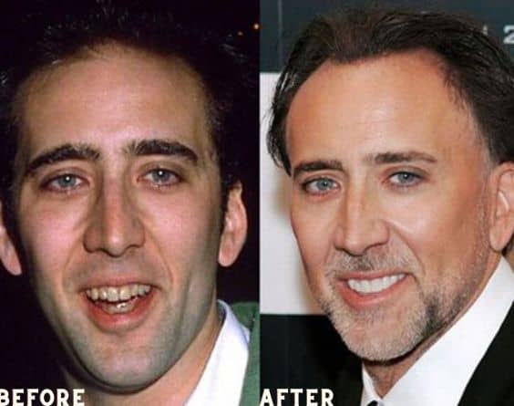 Nicolas Cage is known one of the celebrities with veneers