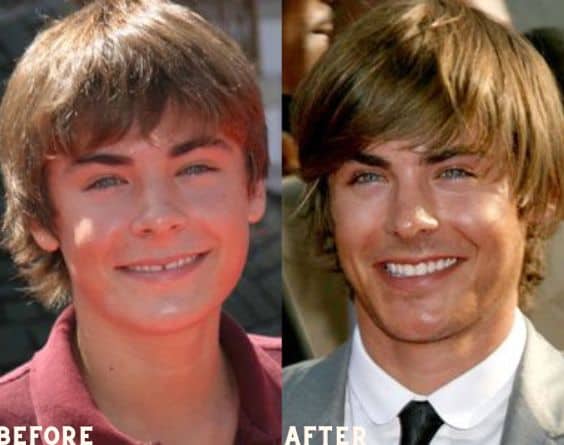 Zac Efron is one of the well known celebrities with veneers
