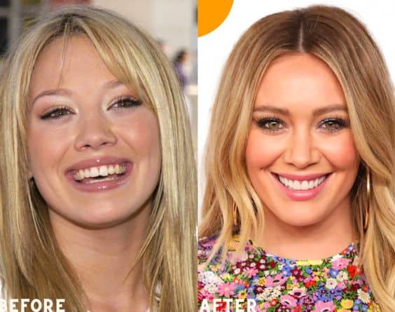 hilary duff is a well known singer and has veneers on her teeth