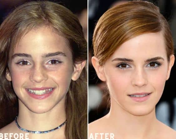 celebrities with veneers Emma Watson