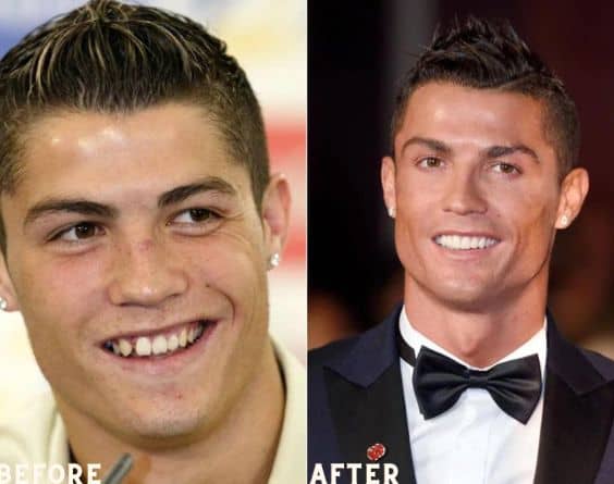 Cristiano Ronaldo is a football player who has veneers on his teeth