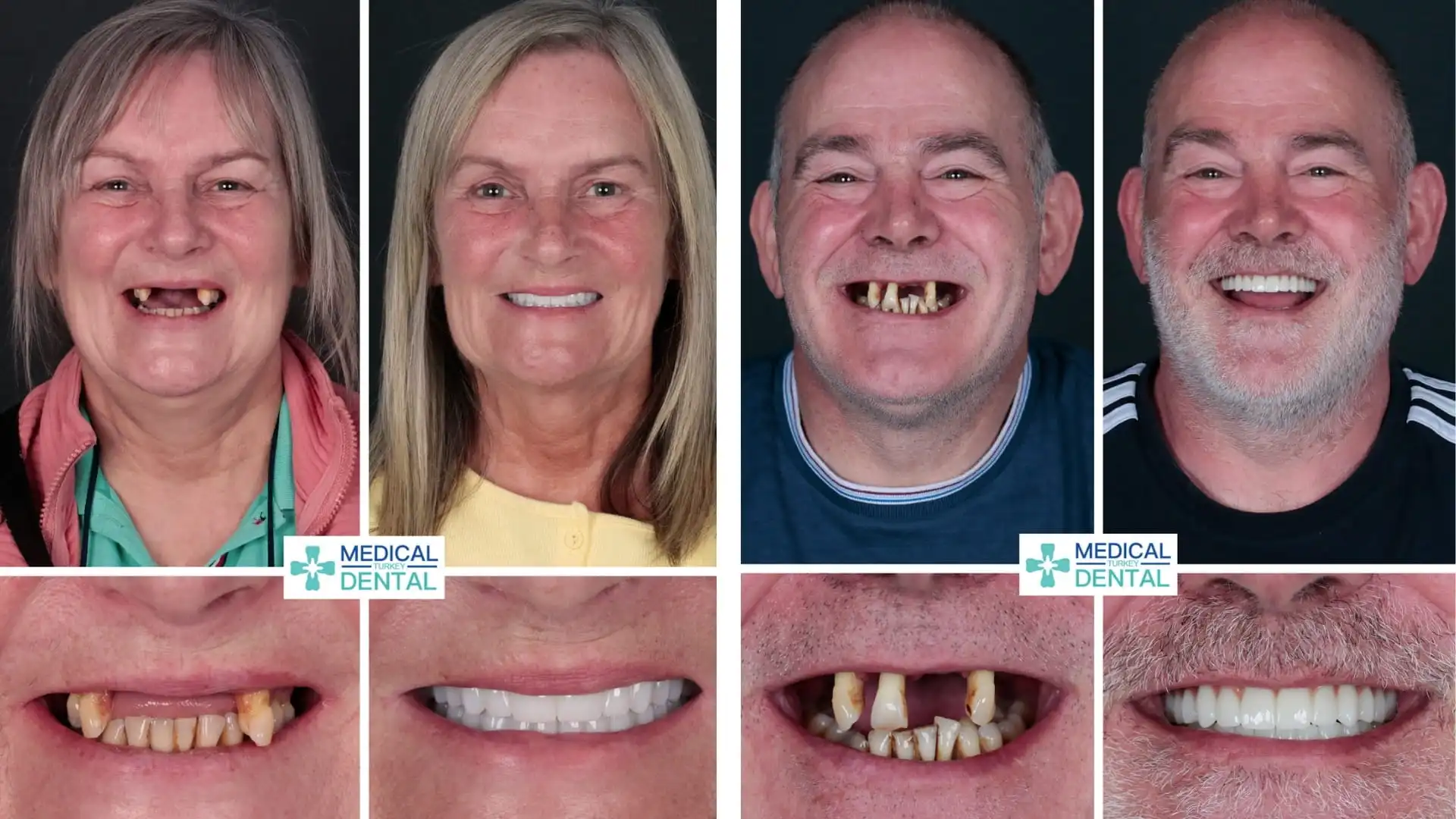 Before after all on 6 implants in Antalya, Turkey - 1