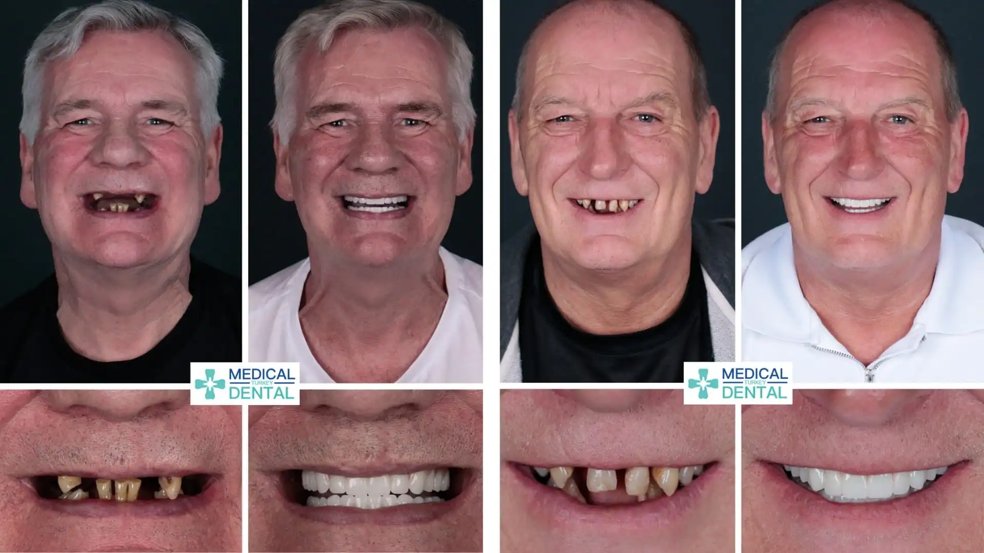 Before after all on 6 implants in Antalya, Turkey - 2