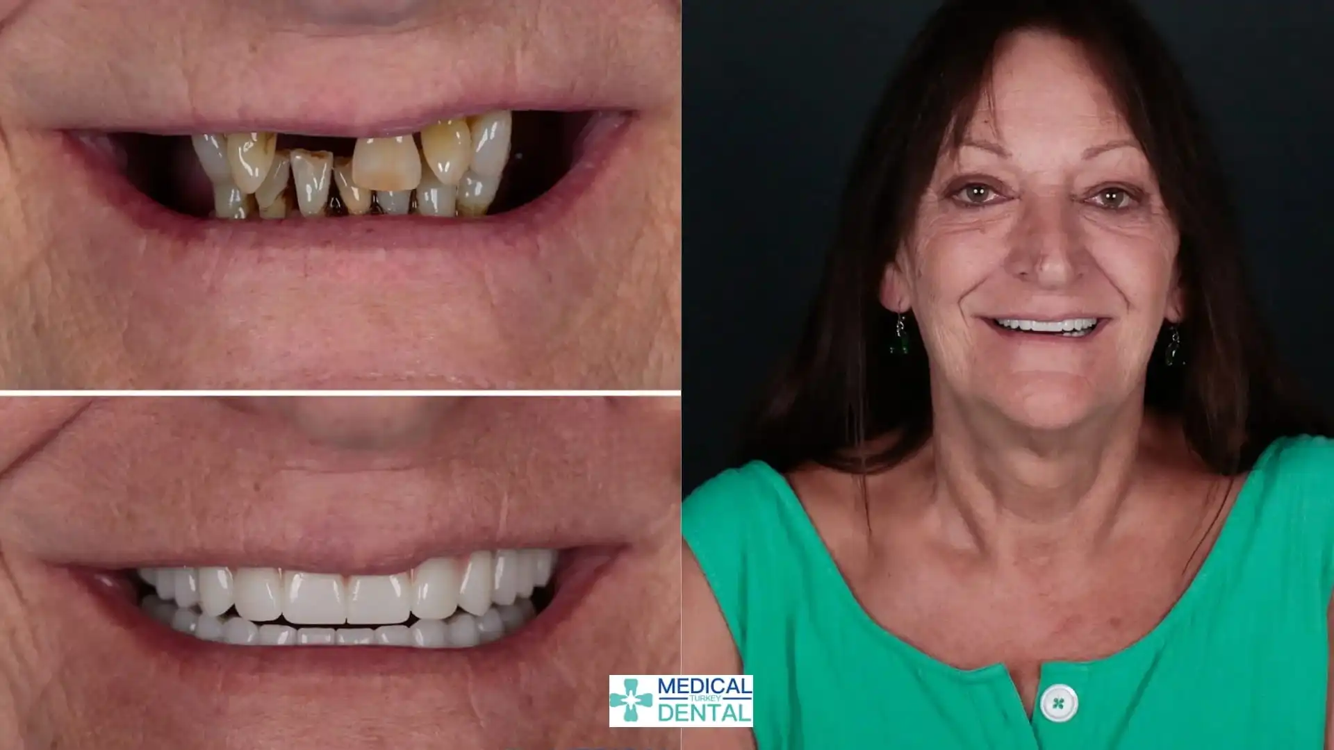 All-on-6 Implant Problems: Signs, Causes & Prevention, Antalya, Turkey