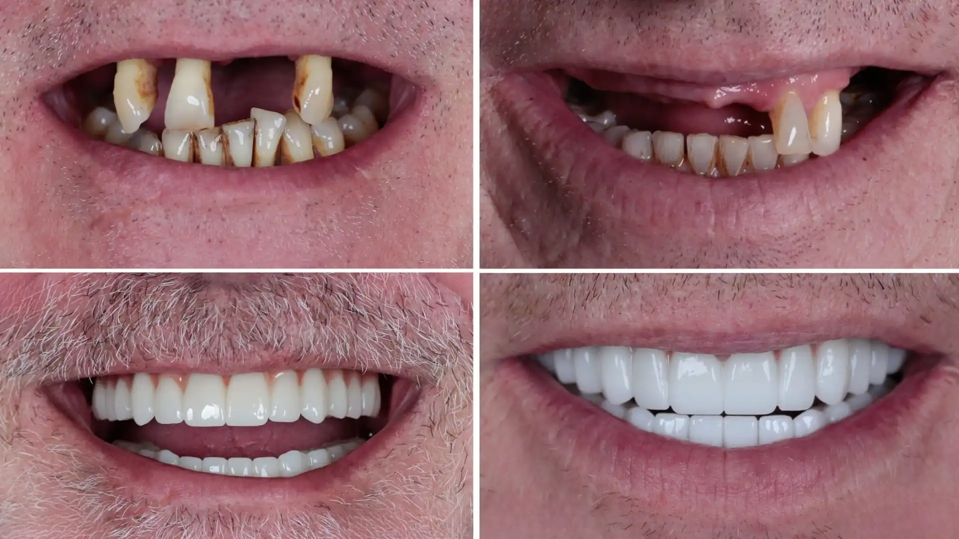 All on 6 dental implants treatment before after recovery