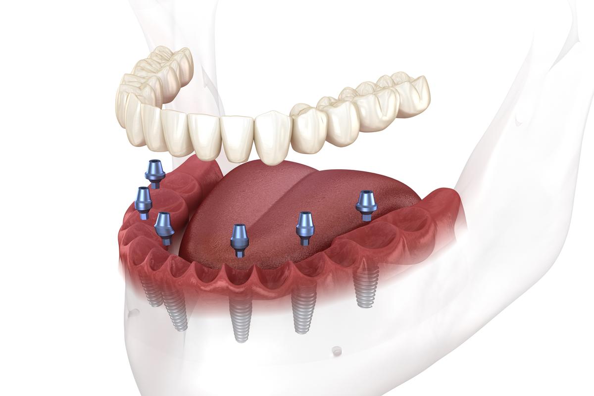 All On 6 Dental Implants Antalya,Turkey Prices