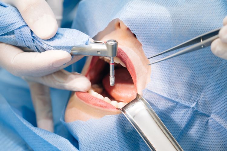 all on 6 dental implants treatment procedures