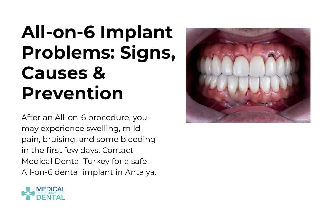 All-on-6 Implant Problems: Signs, Causes & Prevention