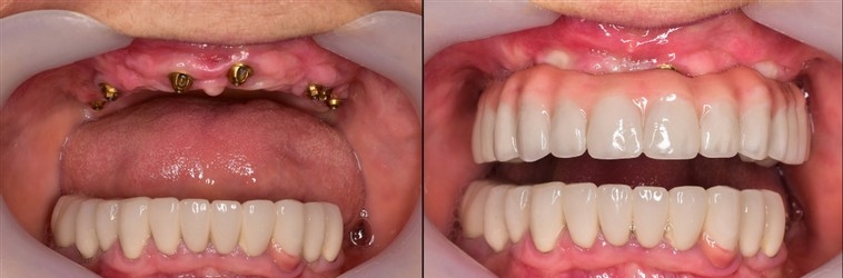 All On 6 Dental Implants Before-and-After Antalya Turkey