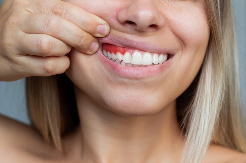 all you need to know about gum grafts