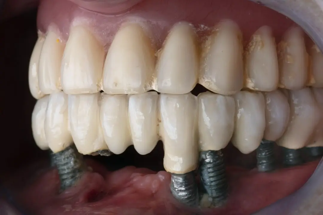 About bad dental implants