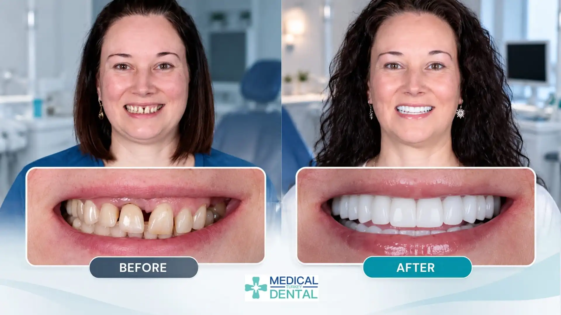 Turkey Teeth Before and After: Real patient result-1