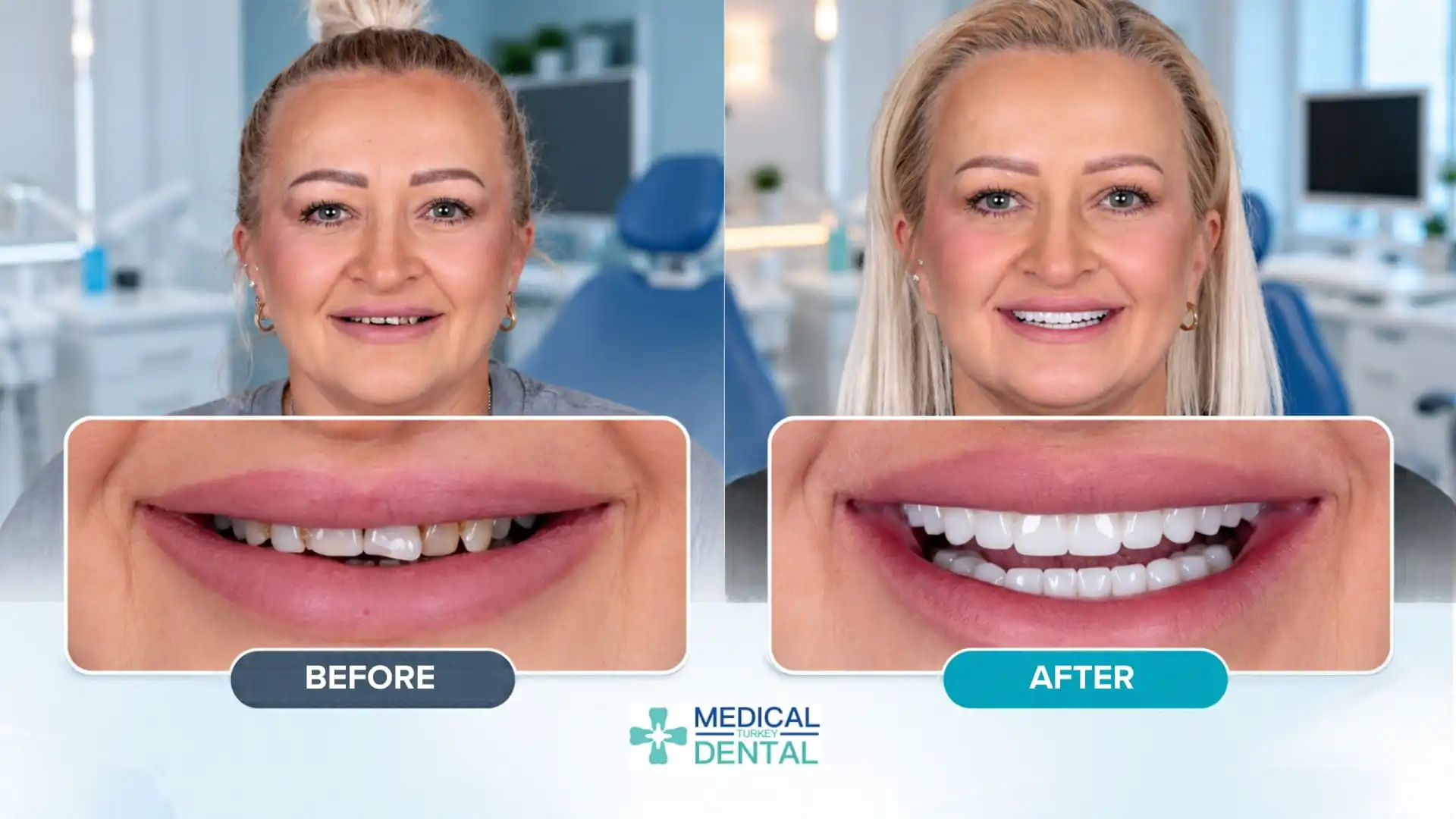 Turkey Teeth Before and After: Real patient results-2