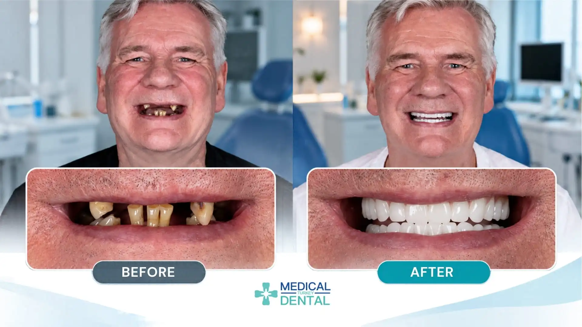 Turkey Teeth Before and After: Real patient results-3