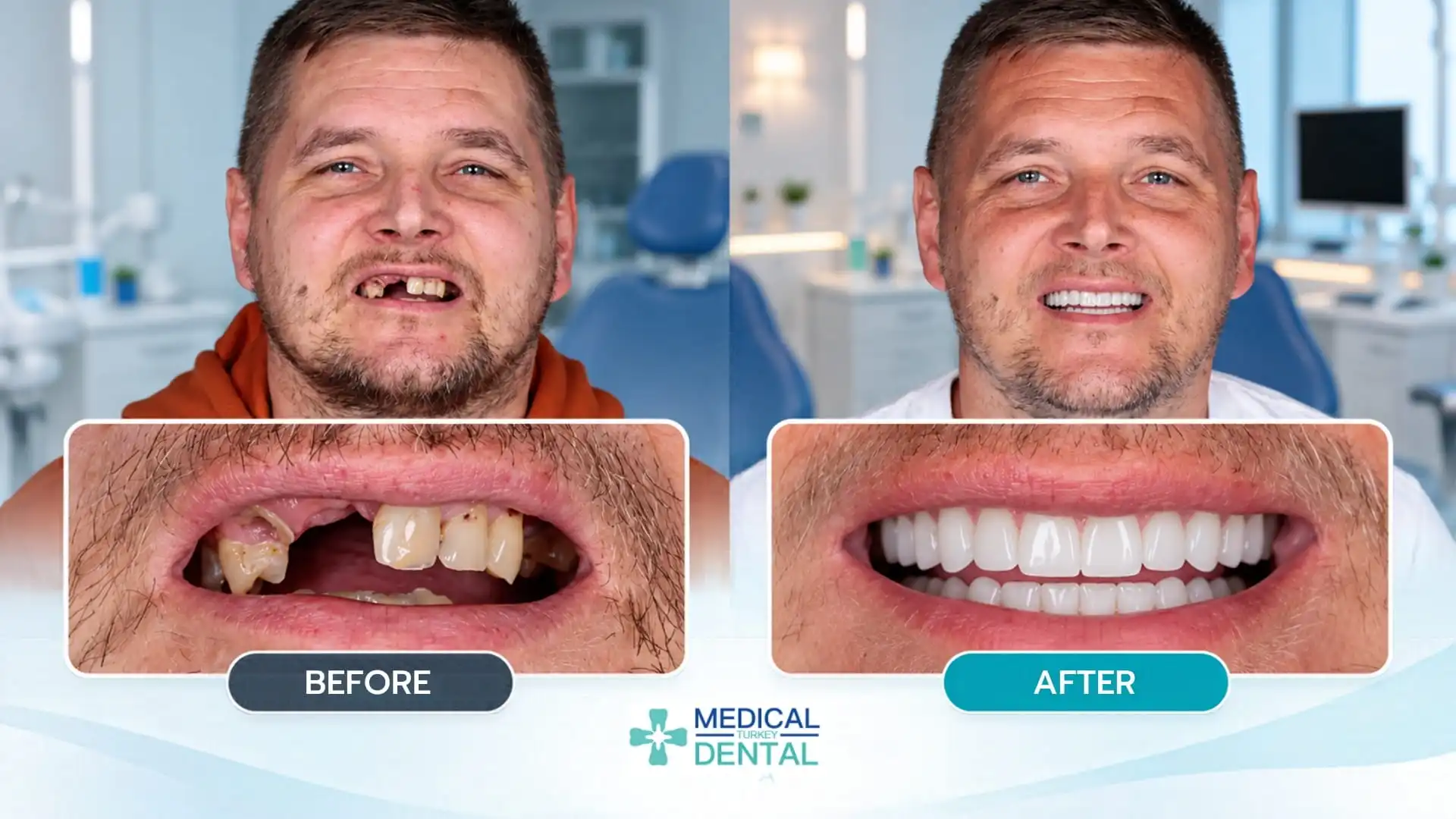 Turkey Teeth Before and After: Real patient results-4