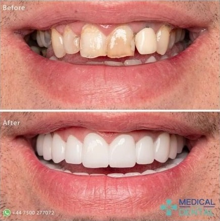 Dental veneers before after taken by medical dental