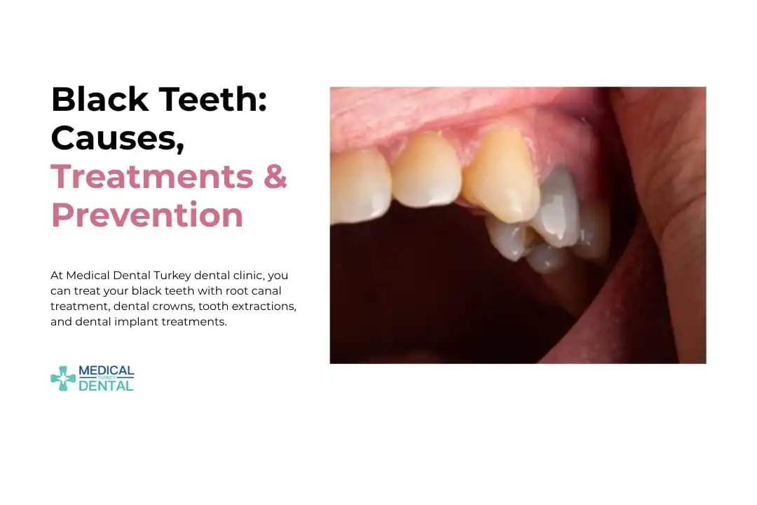 Black Teeth: Causes, Treatments & Prevention in Antalya, Turkey