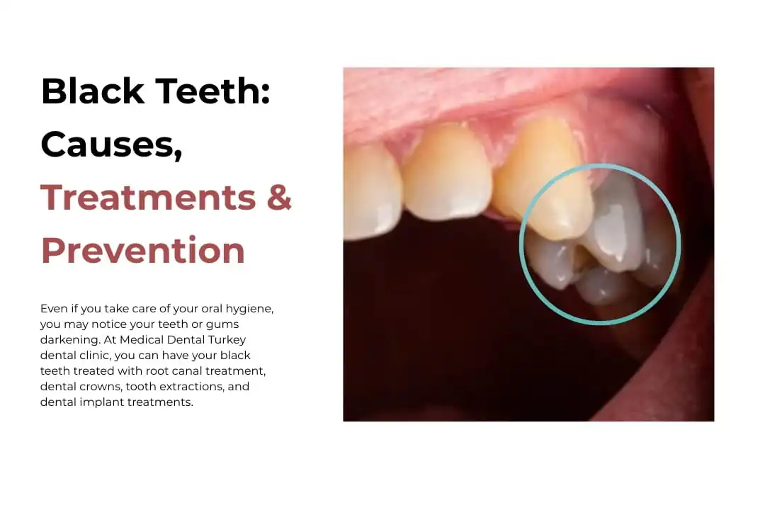 Black Teeth: Causes, Treatments & Prevention in Antalya, Turkey