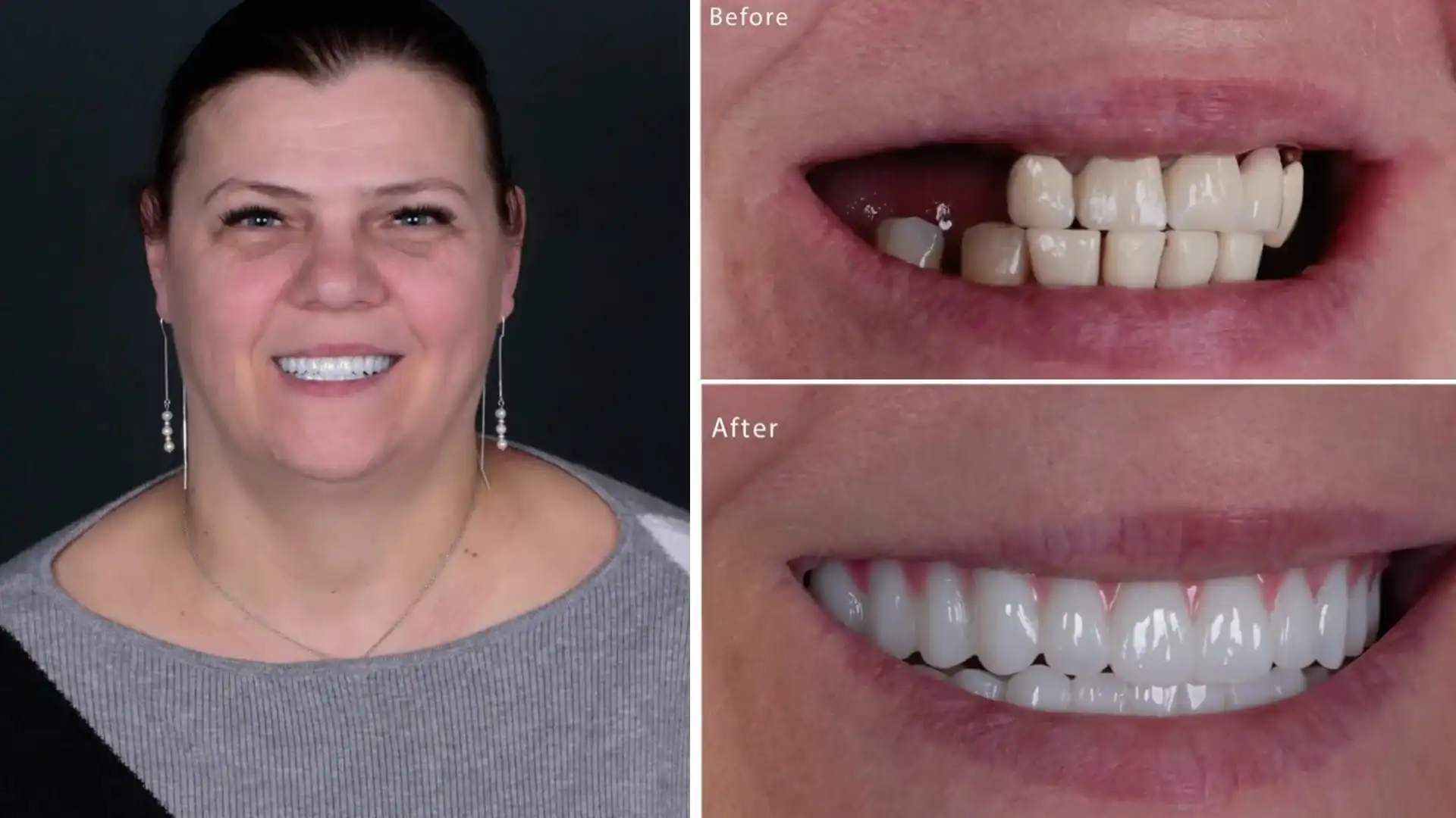 Can dental implants fall out? Antalya, Turkey