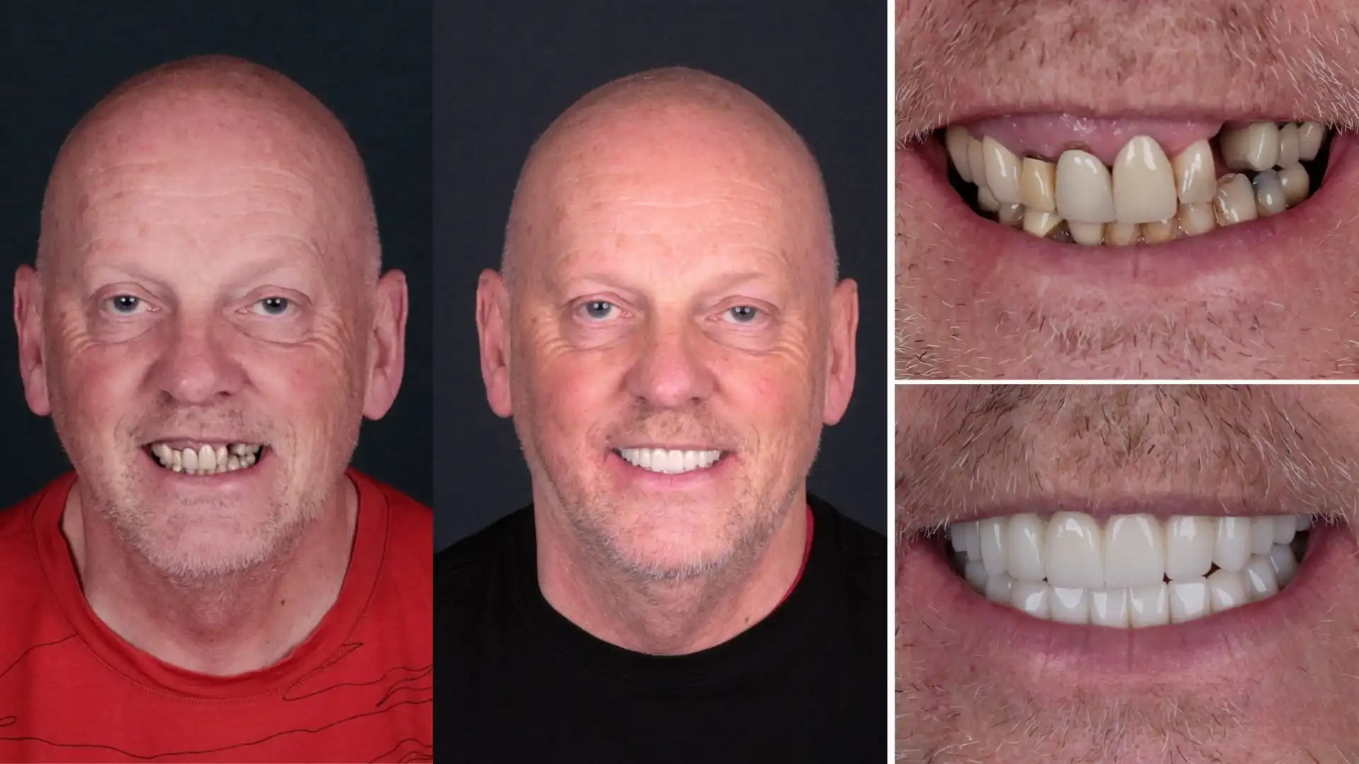 Can you still get dental implants with receding gums?