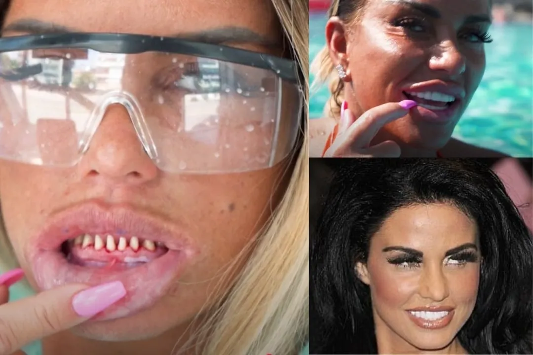 Katie Price teeth before after Katie Price teeth before after