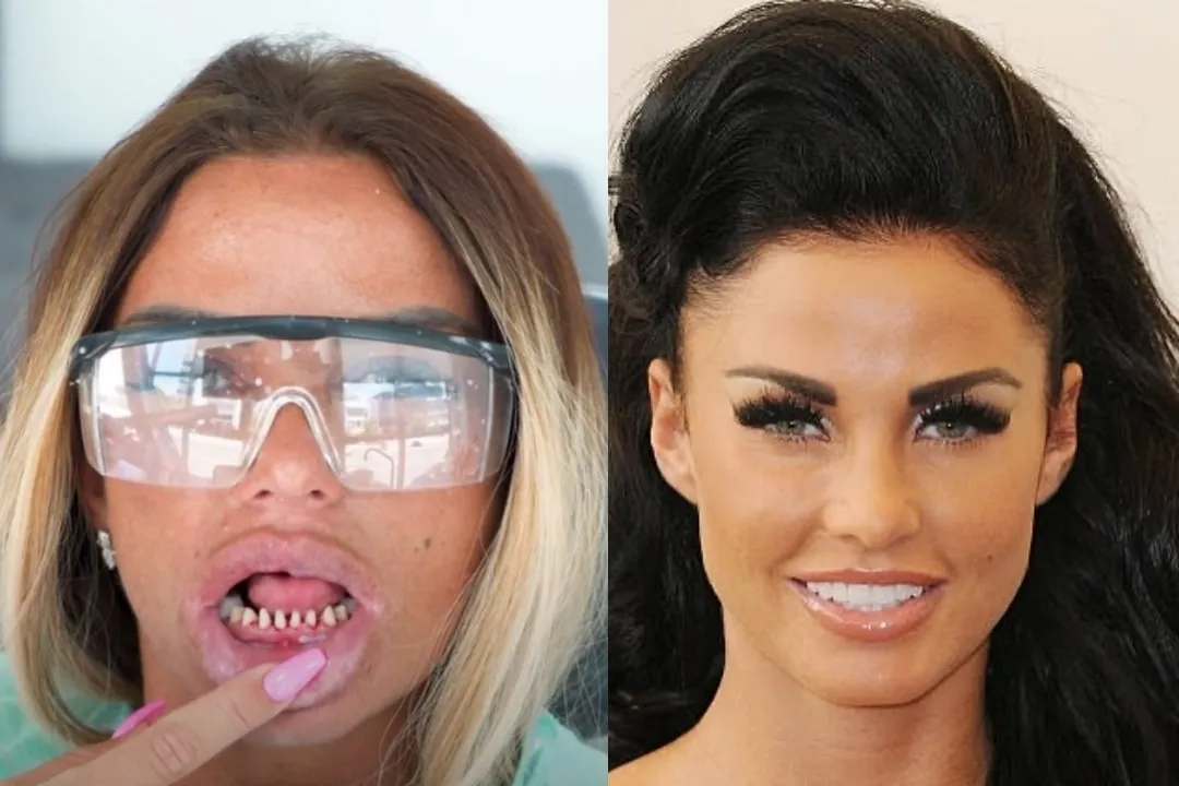 Katie Price teeth before after Katie Price teeth before after