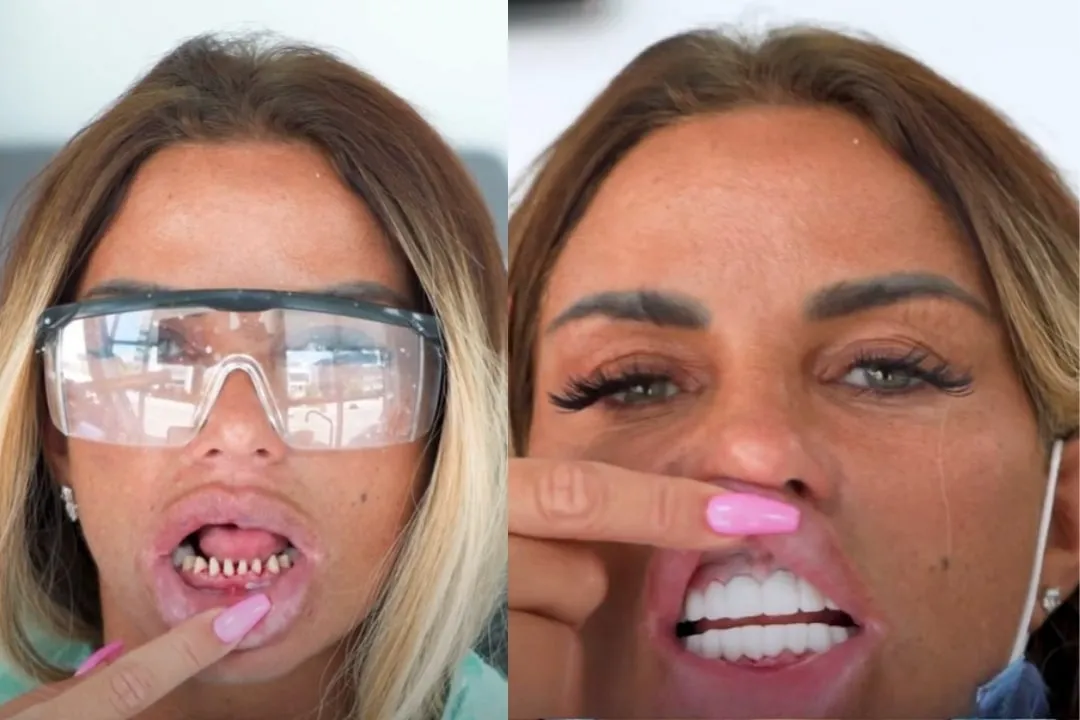 Katie Price teeth before after Katie Price teeth before after
