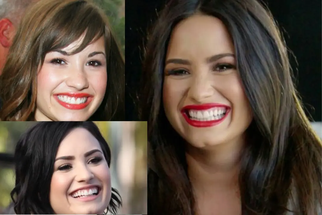 Demi Lovato teeth before after Demi Lovato teeth before after
