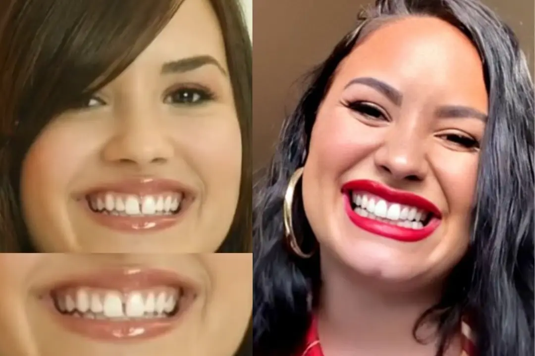 Demi Lovato with veneers before after Demi Lovato with veneers before after