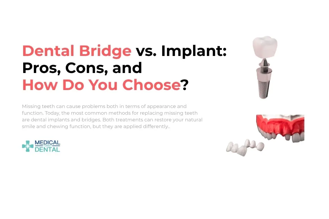Dental Bridge vs. Implant
