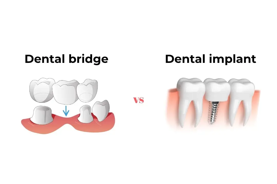 About dental bridges vs. implants Antalya, Turkey