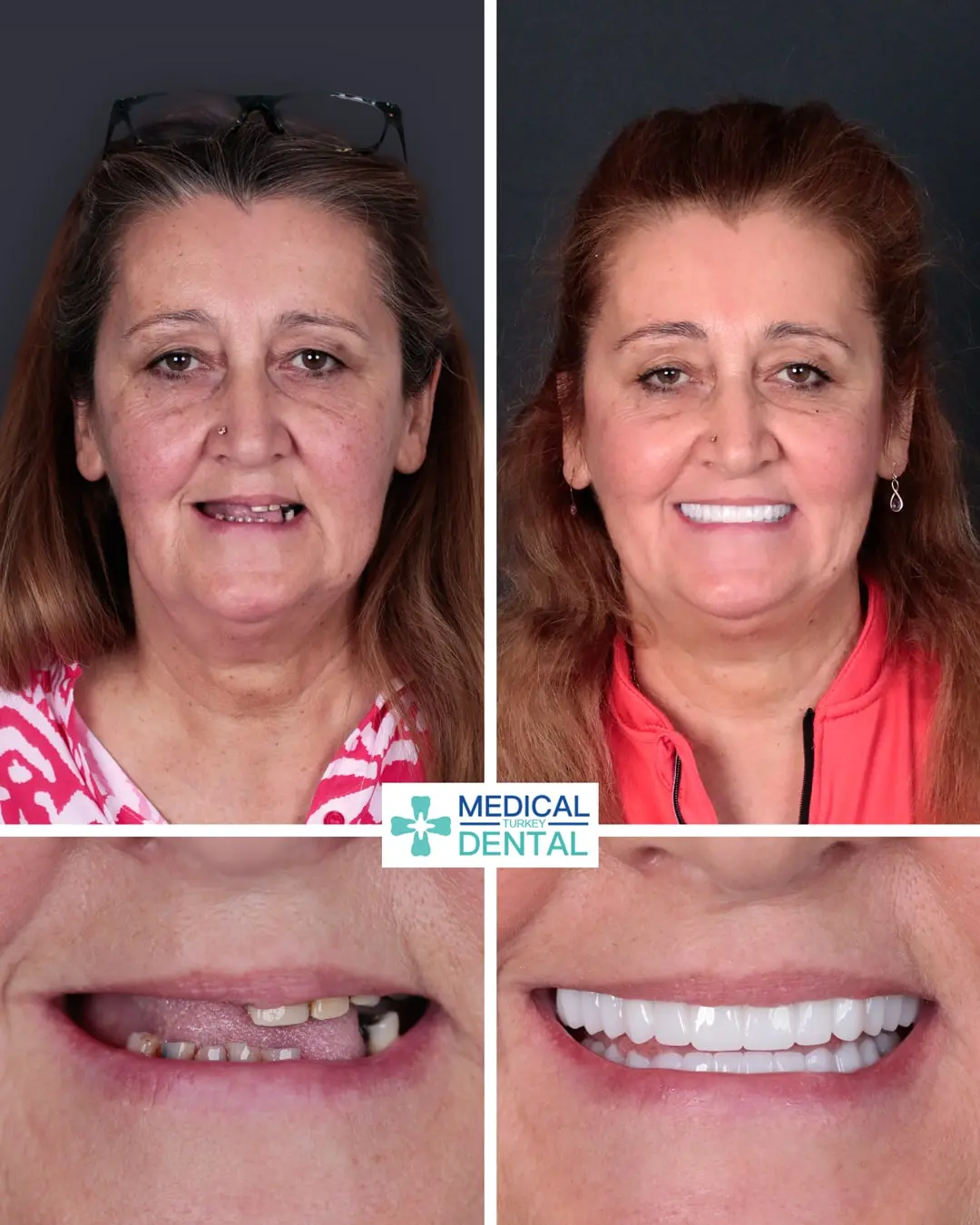 Dental implant before after