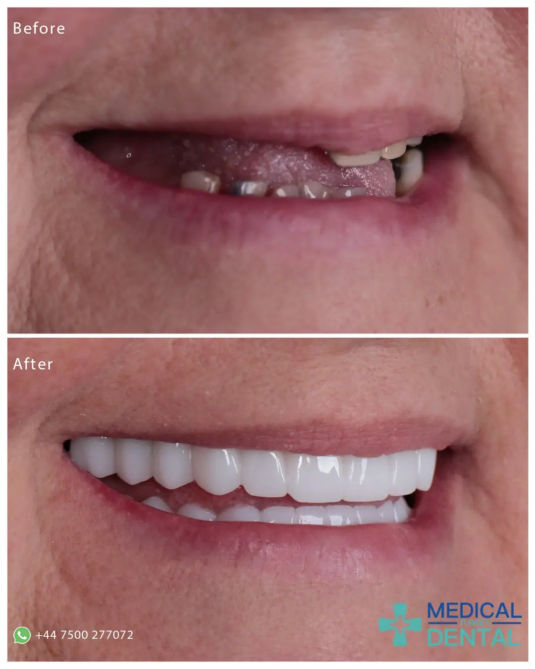 Dental implant before after antalya turkey