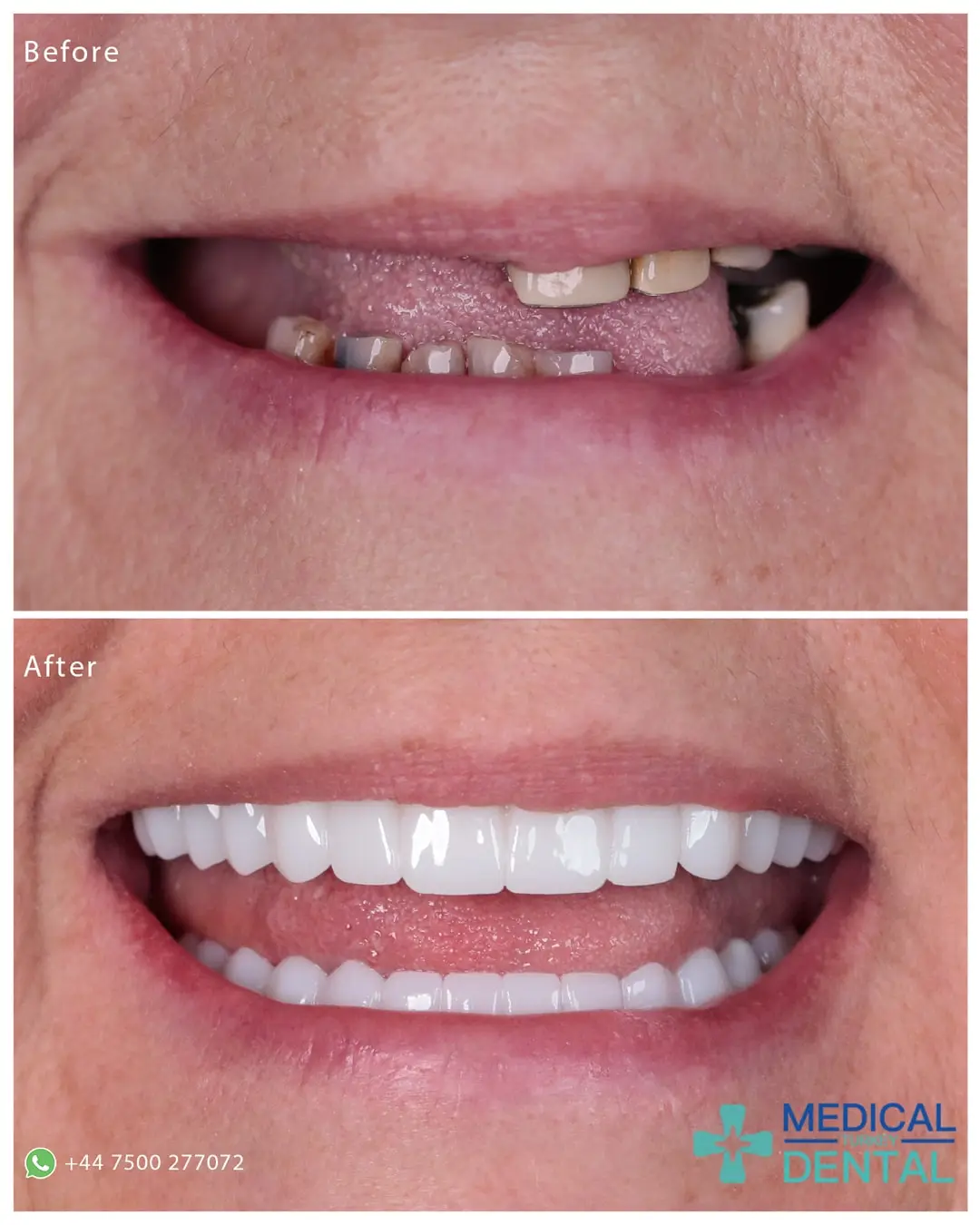 Dental implant before after