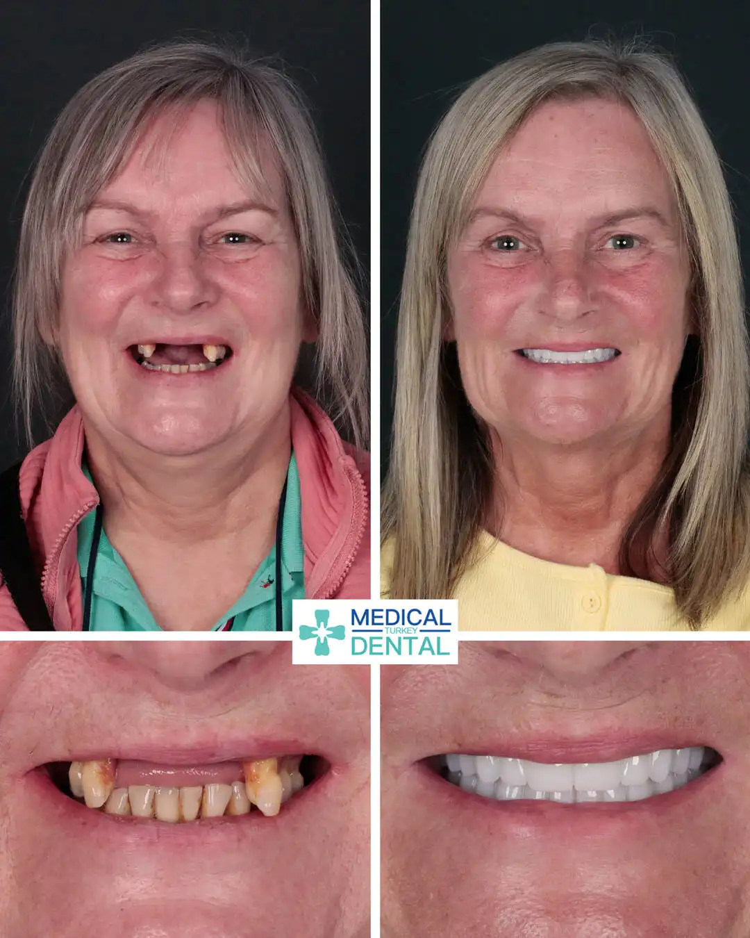 Dental implant before after