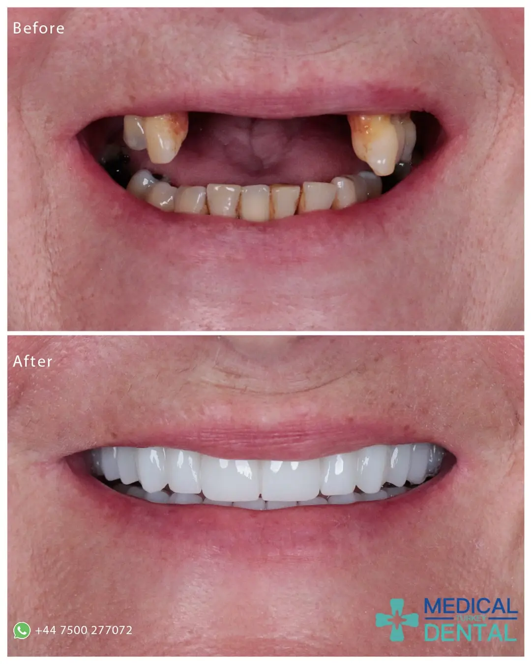 Empress veneers-porcelain veneers