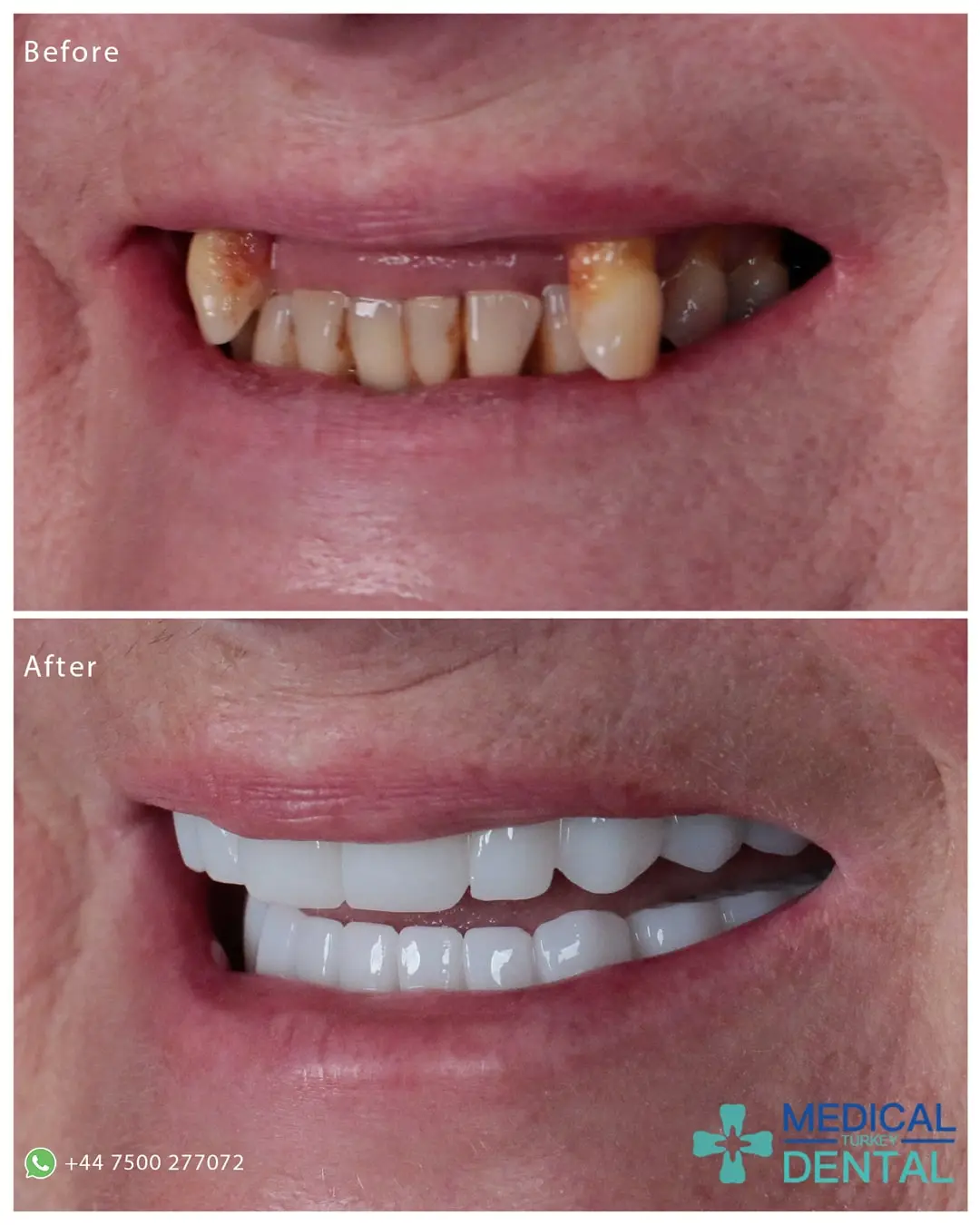 Tooth implant before after antalya turkey