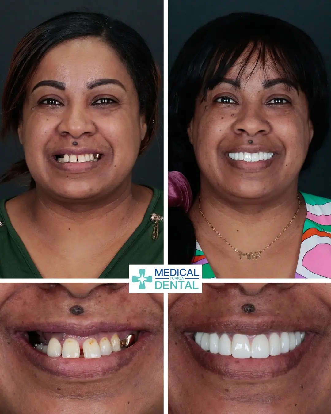 Tooth implant before after antalya turkey