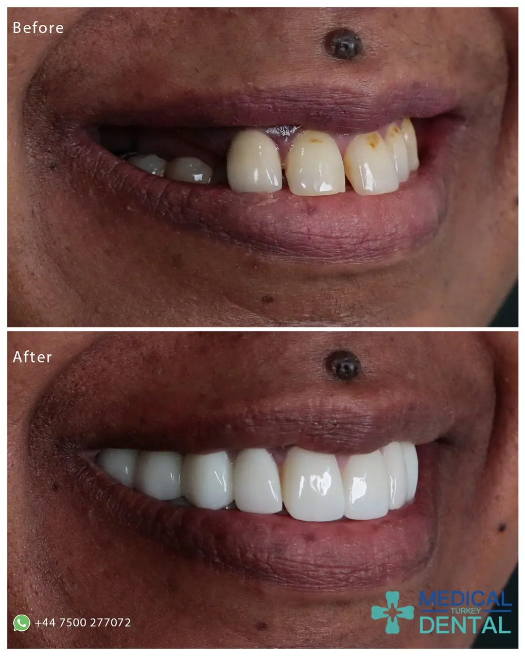 Tooth implant before after antalya turkey