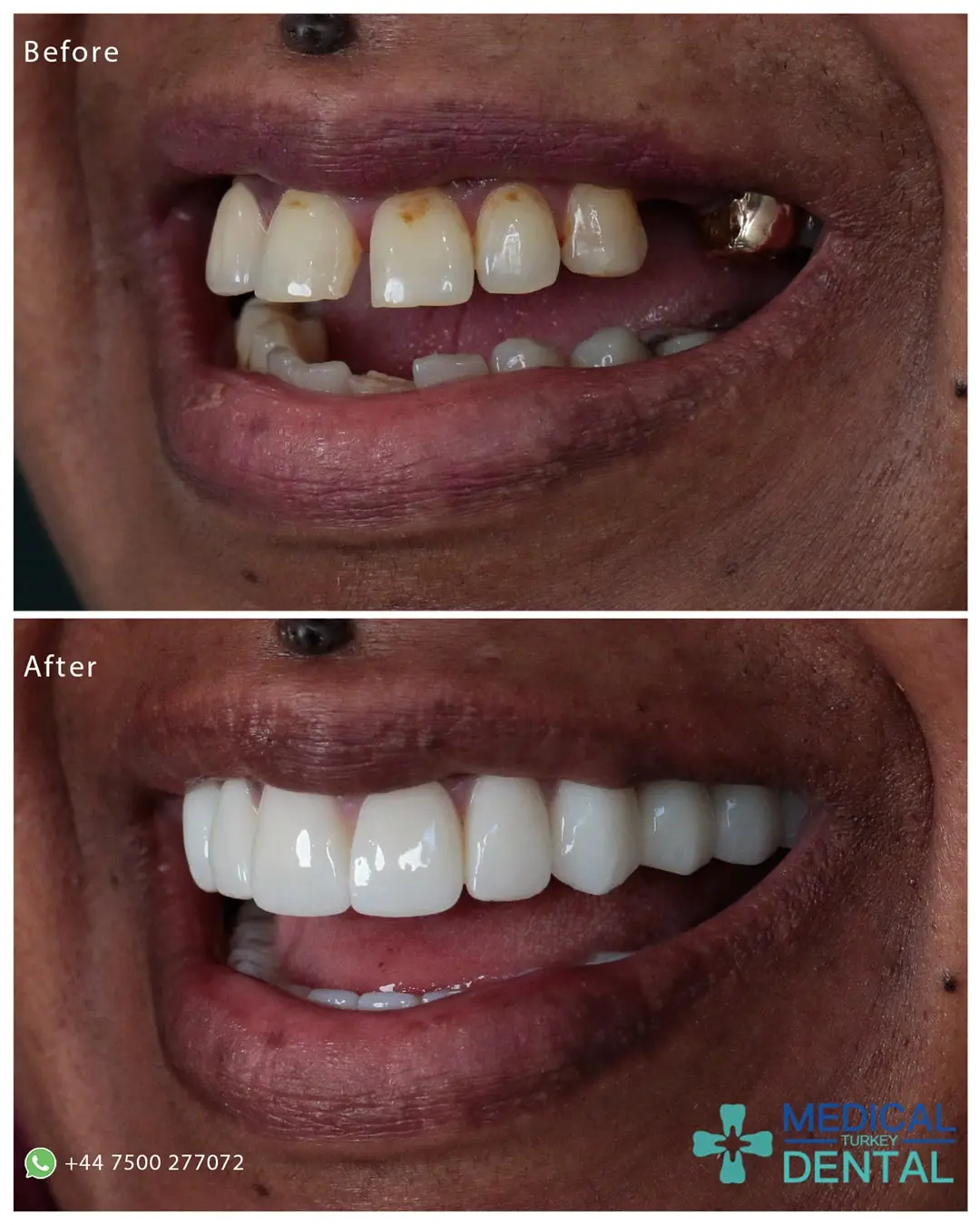 Tooth implant before after antalya turkey