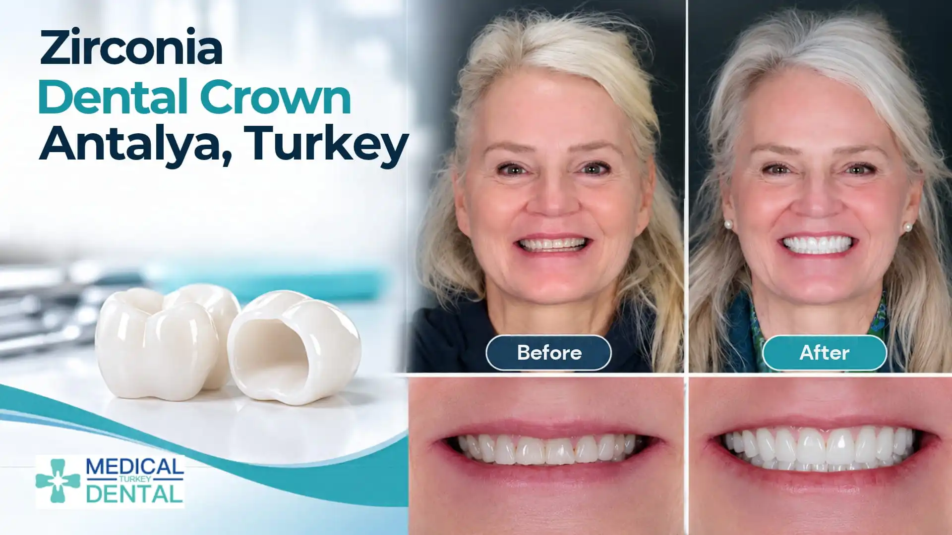 Dental crowns in Antalya, Turkey