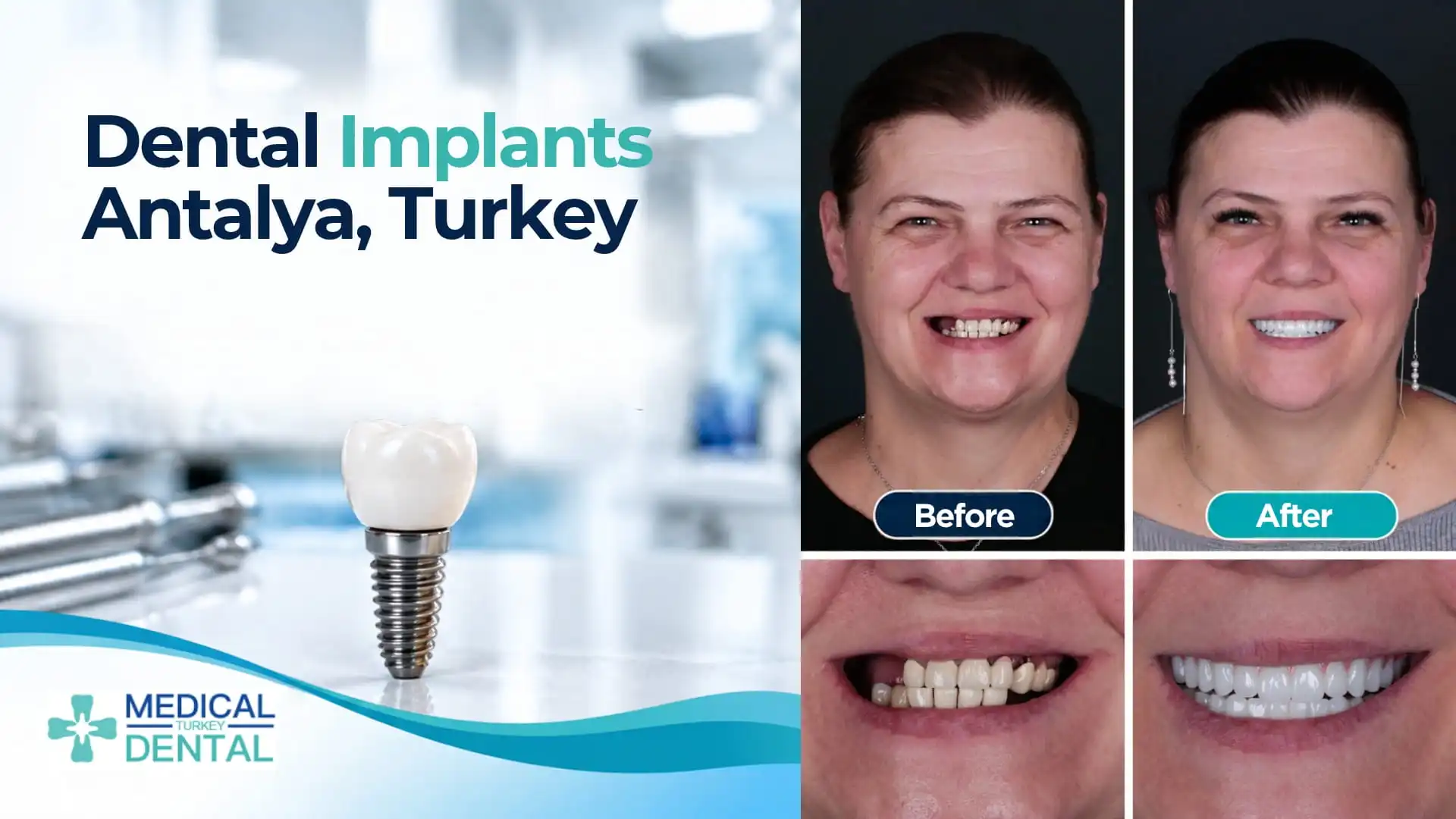 Dental implants in Antalya, Turkey