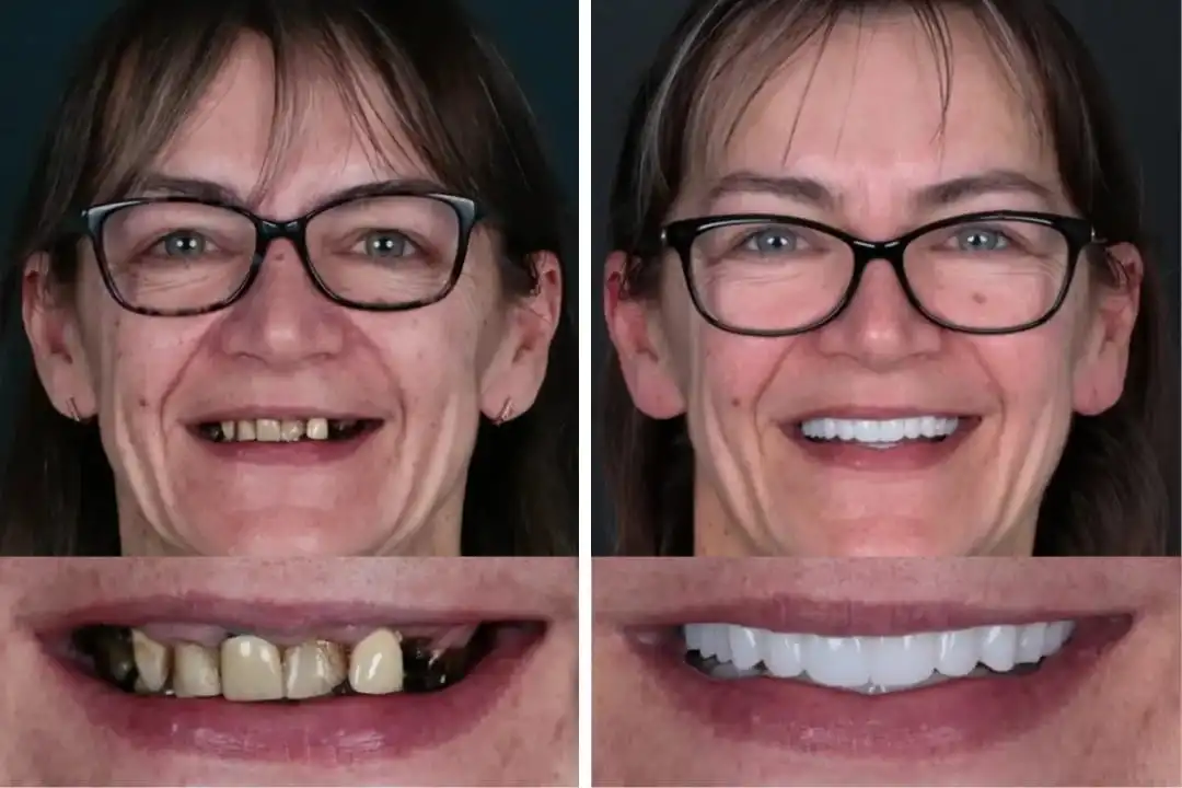 Dental implants or mini implants Antalya, Turkey