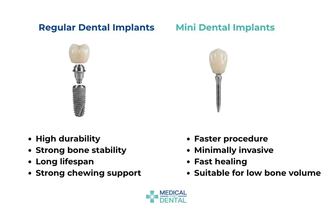 Dental implants or mini implants Antalya, Turkey: Key differences