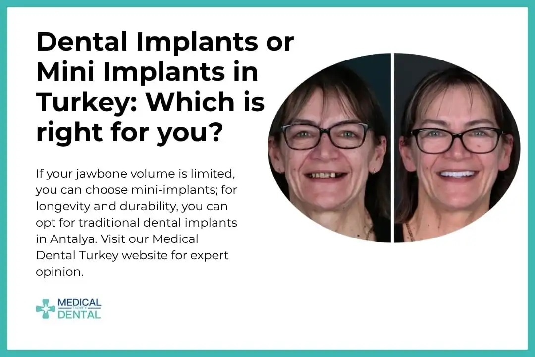 Dental implants or Mini implants in Turkey: Which is right for you?